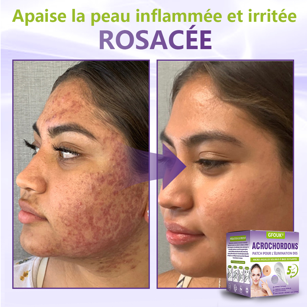 GFOUK® Patch à micro-aiguilles solubles à base de plantes pour l’élimination des acrochordons