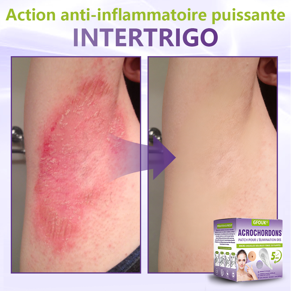GFOUK® Patch à micro-aiguilles solubles à base de plantes pour l’élimination des acrochordons