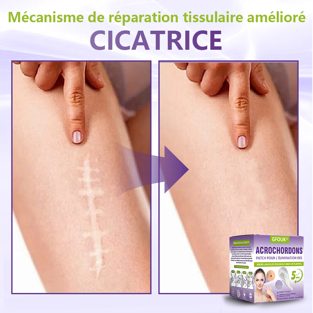 GFOUK® Patch à micro-aiguilles solubles à base de plantes pour l’élimination des acrochordons