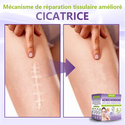 GFOUK® Patch à micro-aiguilles solubles à base de plantes pour l’élimination des acrochordons