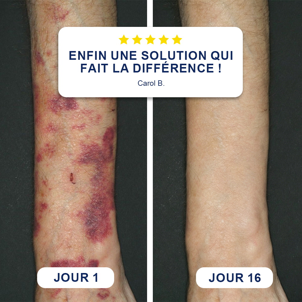 ✨ Crème Evolvion® pour la réparation des ecchymoses et le renforcement de la peau -up