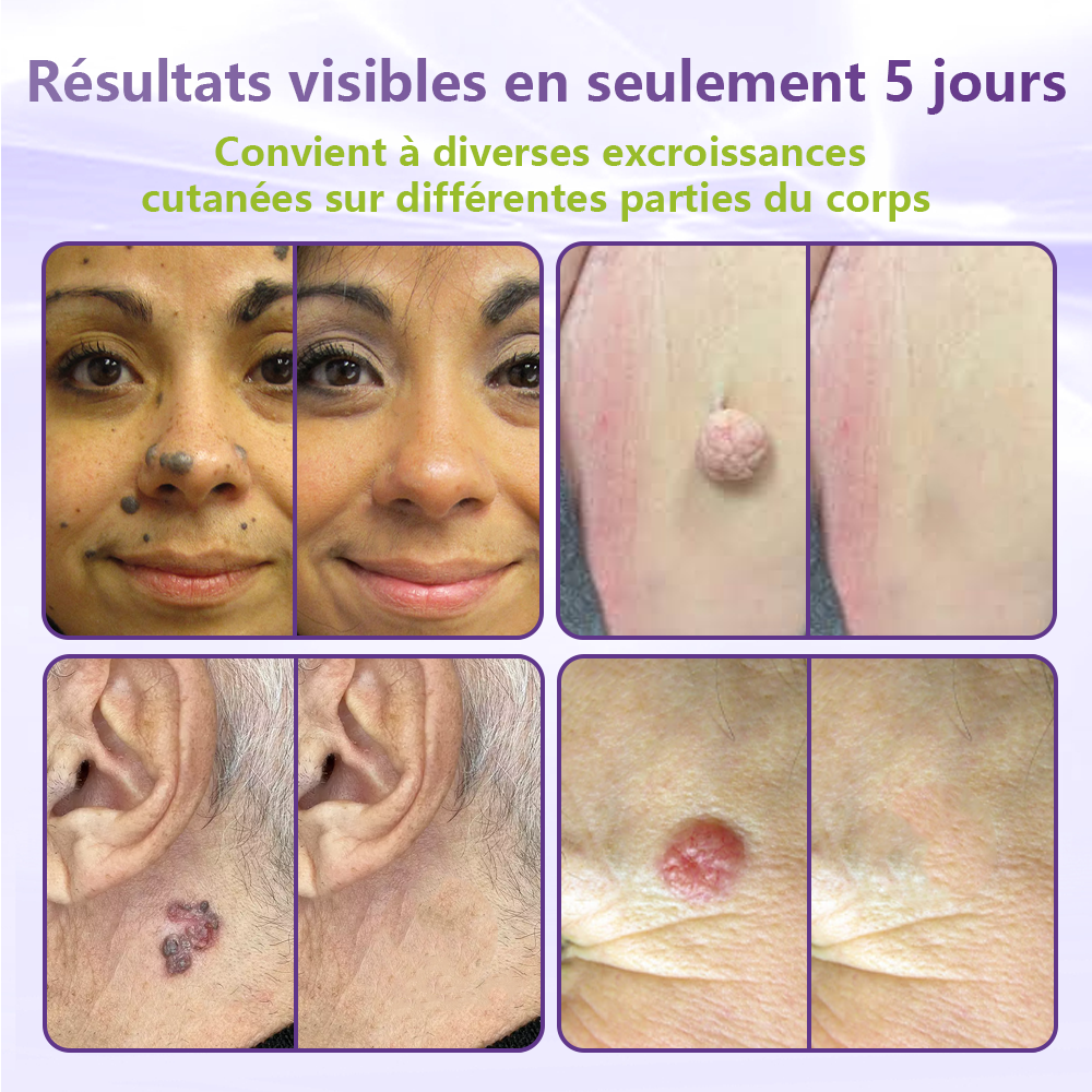 GFOUK® Patch à micro-aiguilles solubles à base de plantes pour l’élimination des acrochordons