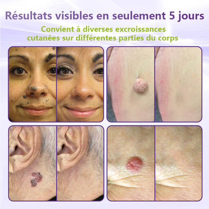 GFOUK® Patch à micro-aiguilles solubles à base de plantes pour l’élimination des acrochordons