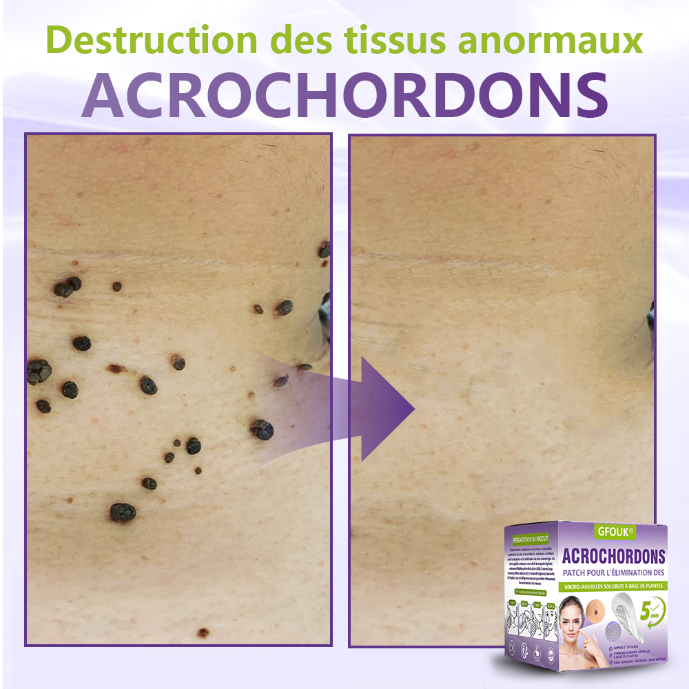 GFOUK® Patch à micro-aiguilles solubles à base de plantes pour l’élimination des acrochordons