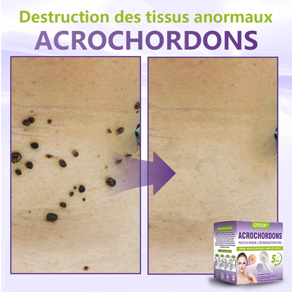 GFOUK® Patch à micro-aiguilles solubles à base de plantes pour l’élimination des acrochordons