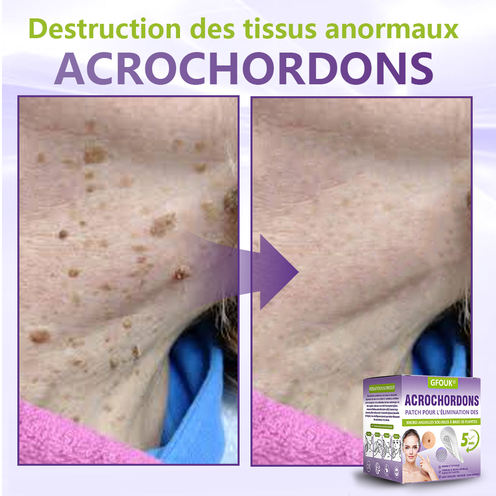 GFOUK® Patch à micro-aiguilles solubles à base de plantes pour l’élimination des acrochordons