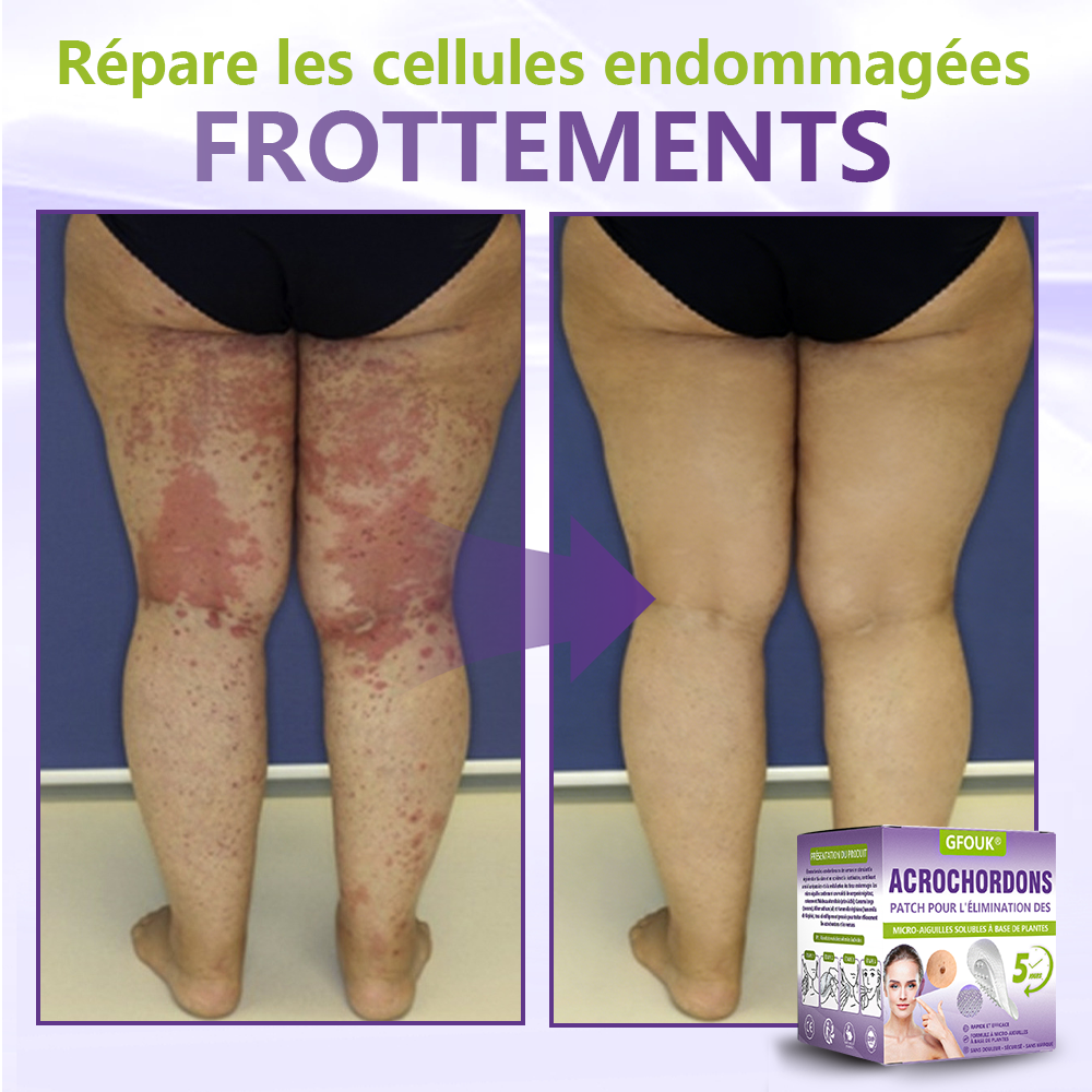GFOUK® Patch à micro-aiguilles solubles à base de plantes pour l’élimination des acrochordons