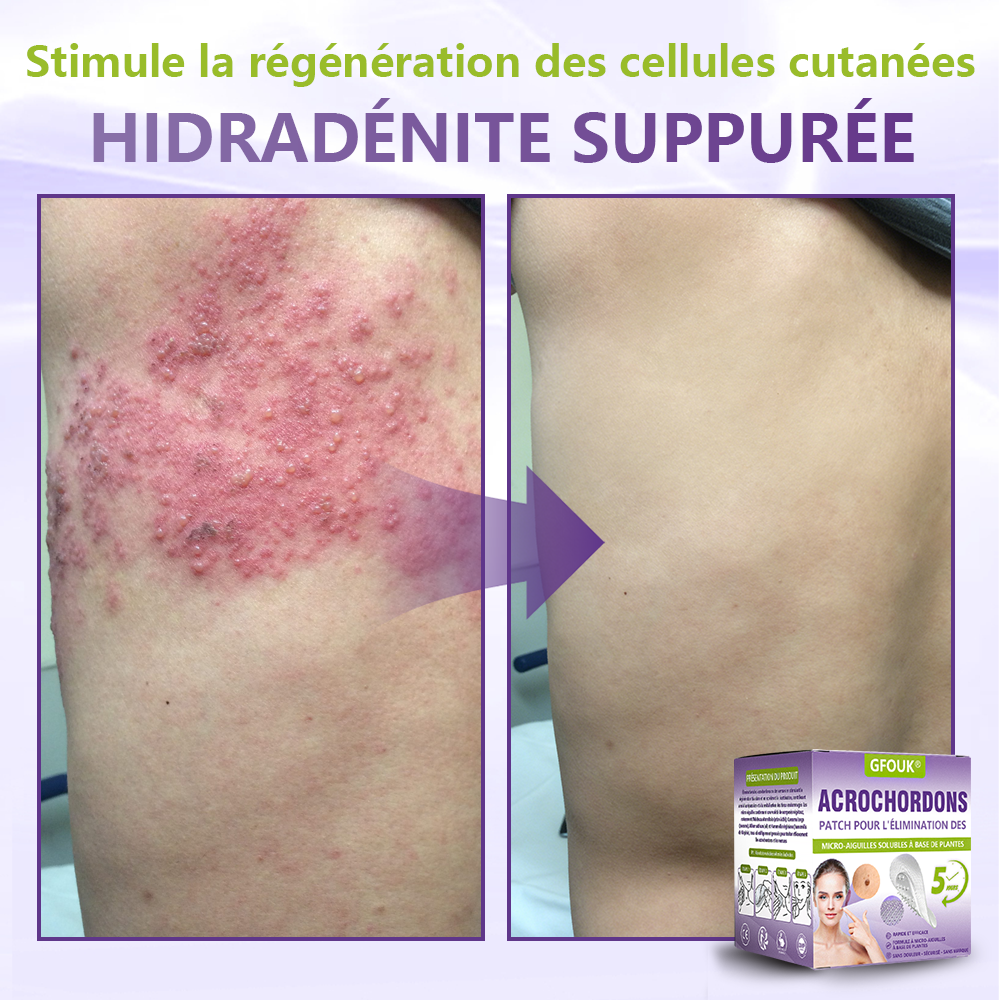 GFOUK® Patch à micro-aiguilles solubles à base de plantes pour l’élimination des acrochordons