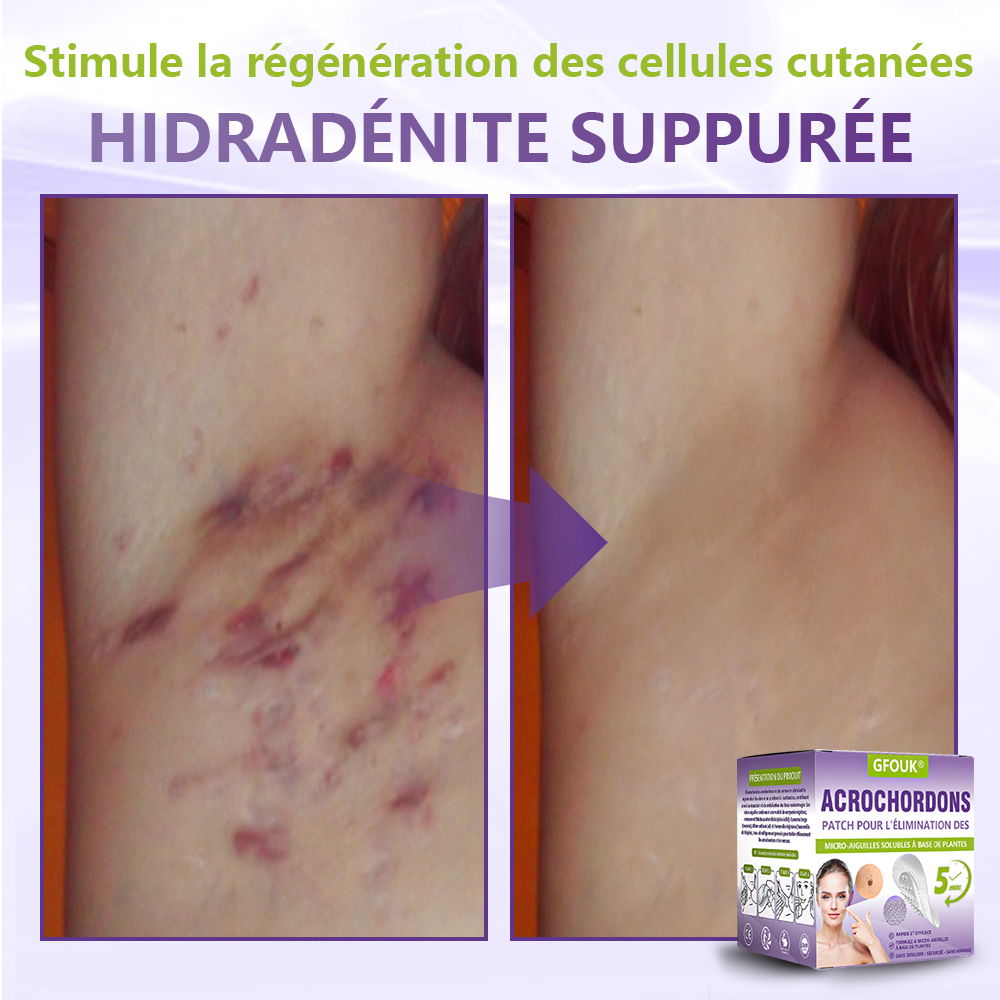 GFOUK® Patch à micro-aiguilles solubles à base de plantes pour l’élimination des acrochordons